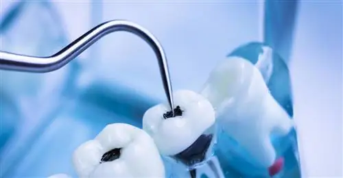 Лечение корневых каналов без секретов