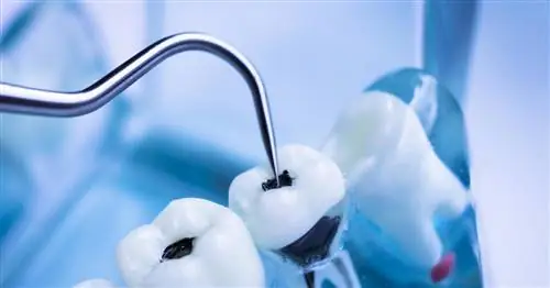 Лечение корневых каналов без секретов