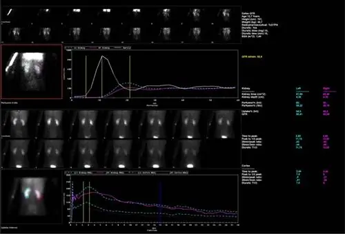 Динамические почки, диабет 1 типа