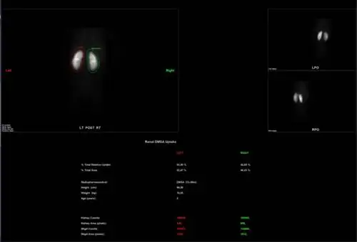 Статика почек в норме, состояние после ОП
