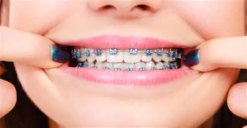 Зубные скобы. Виды брекетов, цена
