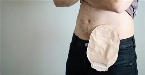 Кишечная стома. Когда появляется стома?