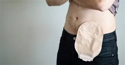 Кишечная стома. Когда появляется стома? Позволяет ли это нормально функционировать? [ОБЪЯСНЯЕМ]