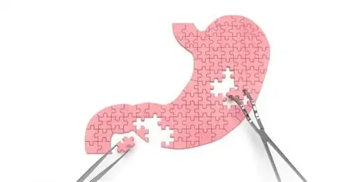 Обнаружен белок, подавляющий развитие рака желудка