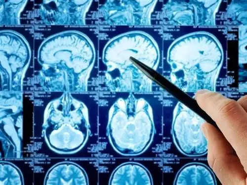Как диагностируется болезнь Альцгеймера?