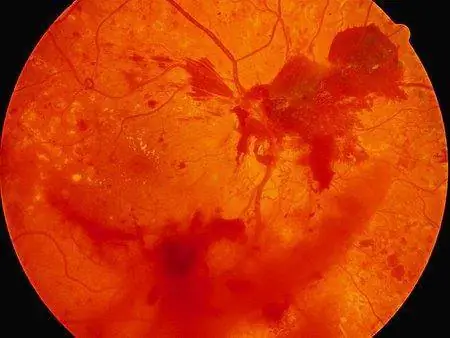 Диабетическая ретинопатия