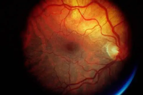 Дегенерация желтого пятна