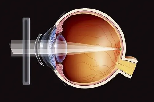 Астигматизм