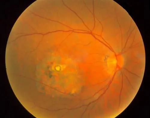 Воспаление и дегенерация сетчатки