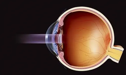 Катаракта (катаракта)