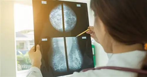 Почему все больше и больше женщин заболевают раком молочной железы? Доктор объясняет