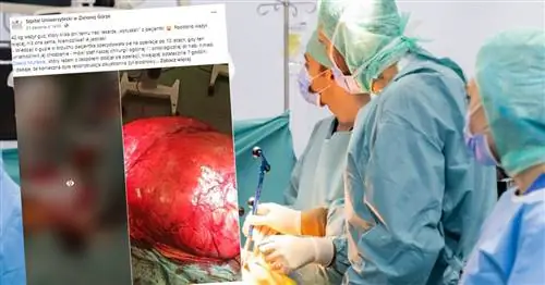 Врачи удалили опухоль, которая весила больше, чем пациент. Она прожила с ним 10 лет