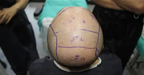 Пересадка волос