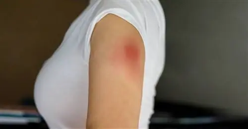 Рука Covid после вакцины Moderna