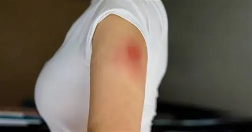 Необычный побочный эффект после прививки Moderna. Опасна ли «Ковидная рука»?