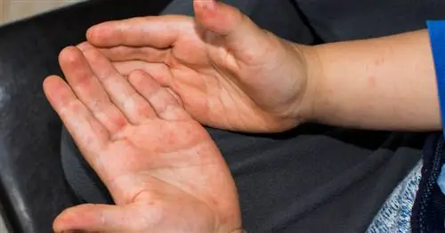 Возможен ли бостон у взрослых?