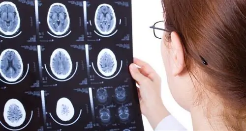 болезнь Крейтцфельдта-Якоба