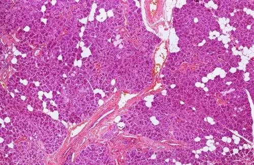 Красная волчанка