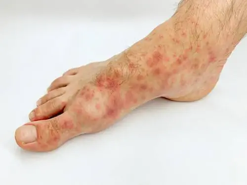 "Ковидные пальцы"