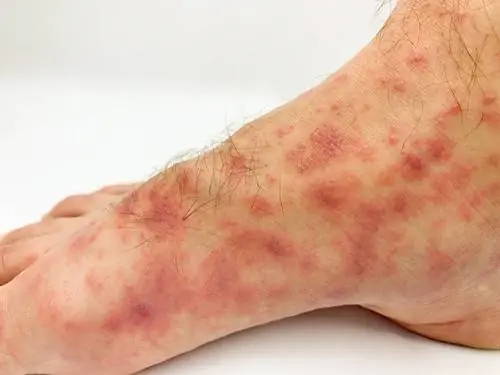 Поражения кожи, связанные с COVID-19