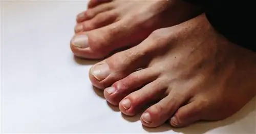 Красно-фиолетовые пятна, волдыри. Что такое «ковидные пальцы»?