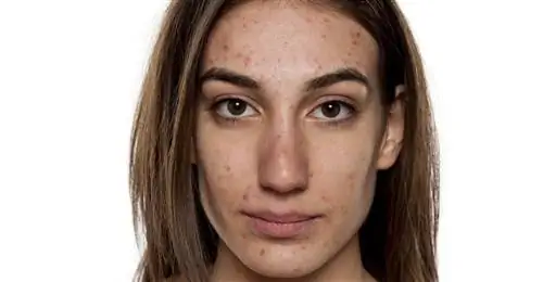 Акненормин