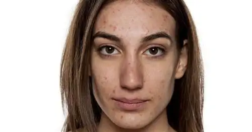 Акненормин - показания, противопоказания, побочные эффекты, заменители