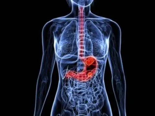 Рак желудка