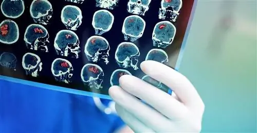 Коварные аневризмы