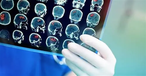 Коварные аневризмы