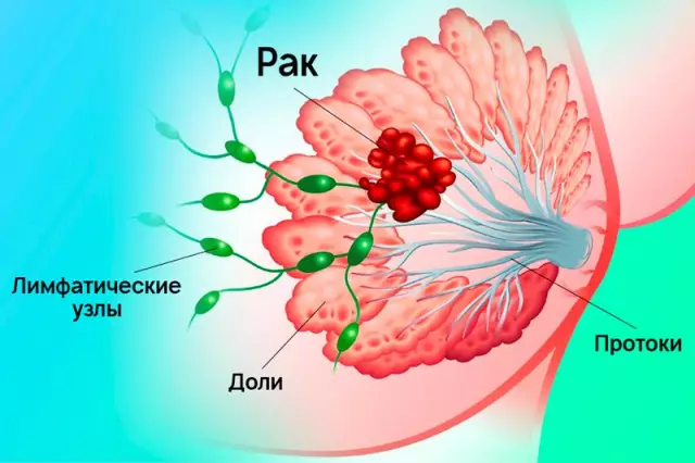 Рак молочной железы: резать хлеб, чтобы защитить себя