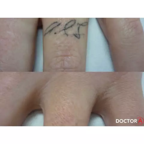 Удаление татуировки: как это происходит? Насколько они эффективны?