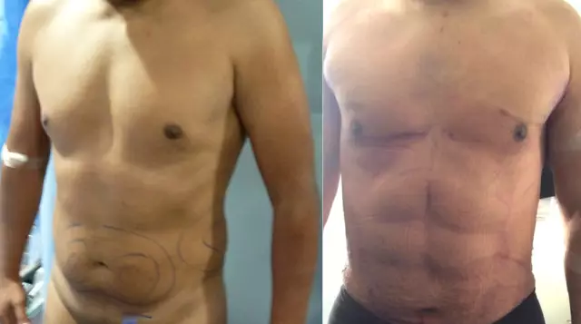 Революционный метод липосакции 4D Vaser Lipo был также представлен в Греции известным пластическим хирургом доктором Athanasiou