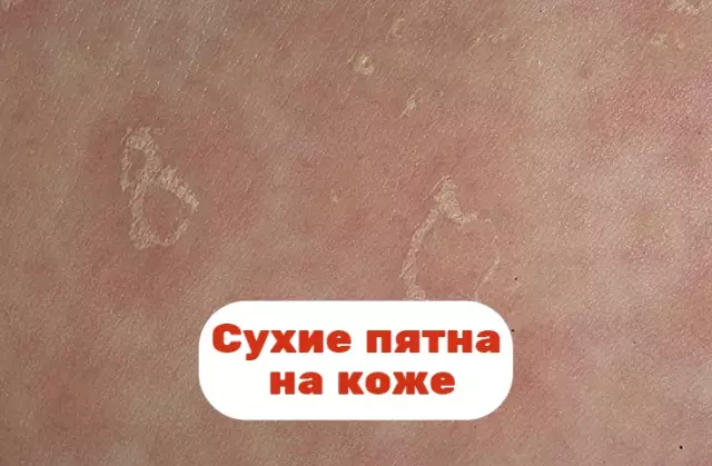 Пятна старения на коже: симптомы, причины и профилактика