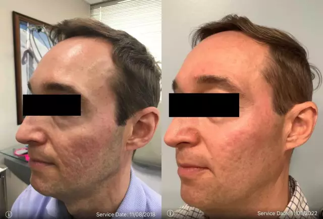 2 года: победитель The Laser Fractional, стоимостью 250 евро, от пластического хирурга Георгиоса Андреанидиса