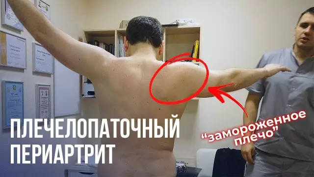 Замороженное плечо: какой неизвестный синдром достигает 50 пунктов