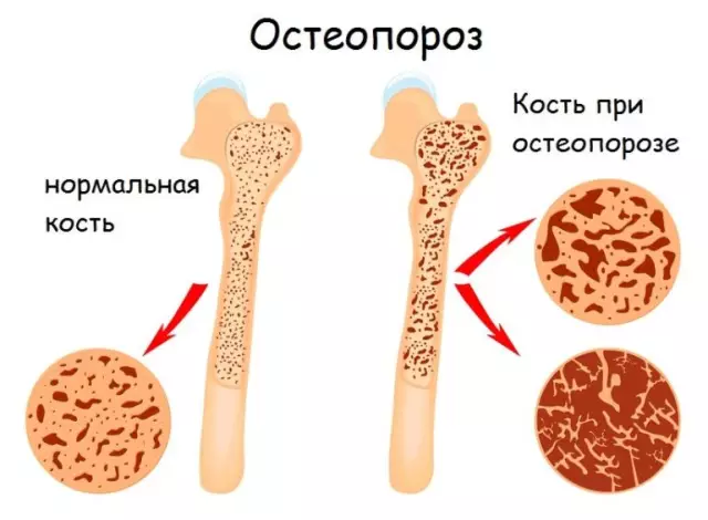 Остеопороз: неявное заболевание без симптомов - на что обратить внимание