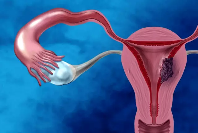 Рак матки: насколько возрастает риск в зависимости от окружности талии