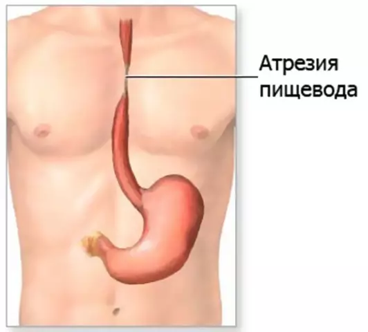 Атрезия пищевода: опасная врожденная патология и ее лечение