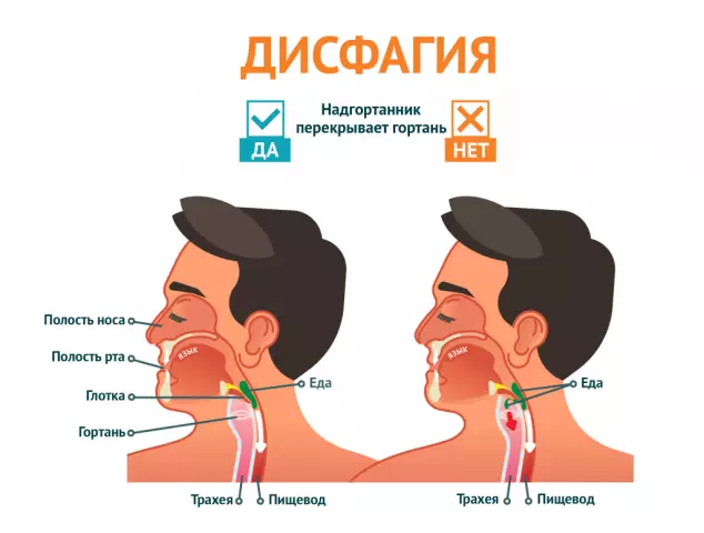 Дисфагия: симптомы опасного синдрома