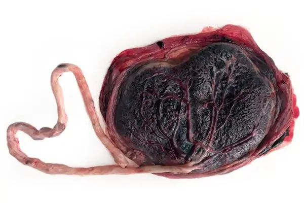 Placenta Accreta: причины, симптомы и лечение