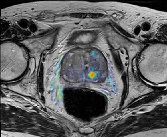 Выжидательная тактика как вариант лечения множественной миеломы
