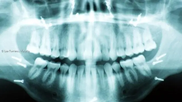 Рак вульвы: симптомы, причины, лечение и профилактика