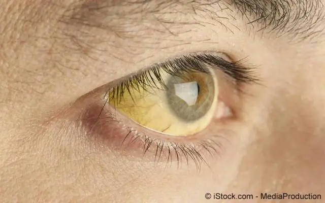 Что такое первичный рак печени?