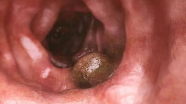 Ранние симптомы колоректального рака у мужчин и женщин