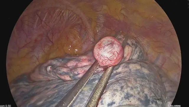 Осложнения рака легких