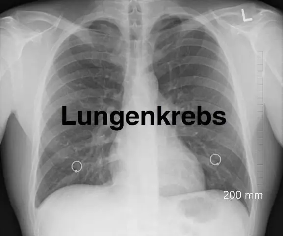 Эмоциональная сторона рака легких