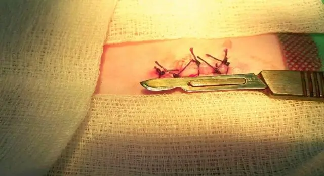 Рак яичек: самообследование дома