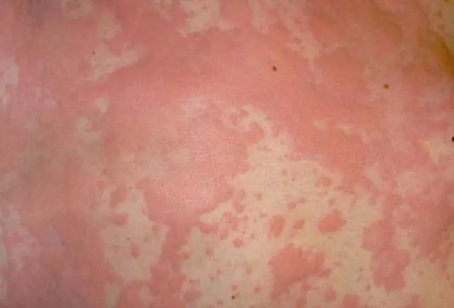 Подростковая депрессия: причины, симптомы, наследственность и лечение