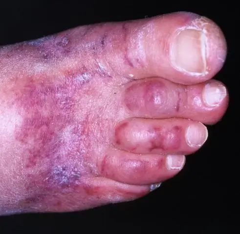 Диабет и ампутация: как болезнь влияет на ваши ноги и ступниДиабет и ампутация: как болезнь влияет на ваши ноги, ступни